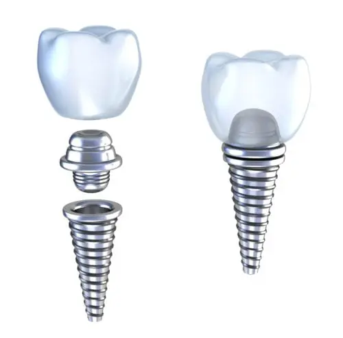 implant dentistry bethlehem pa