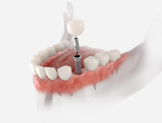 replace missing teeth in Bethlehem PA