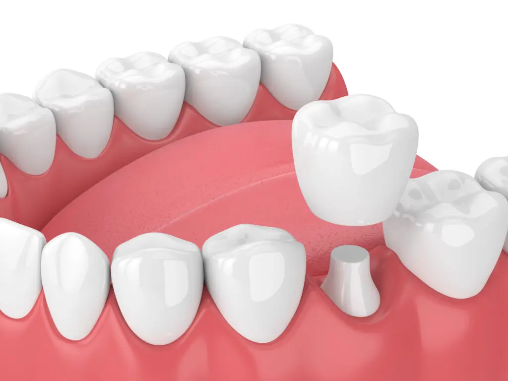 dental crown bethlehem pa