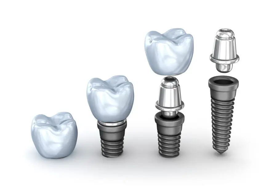 Why Bethlehem Dental Implants Are the Preferred Tooth Replacement Option
