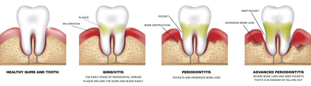 treatment for gum disease bethlehem pa