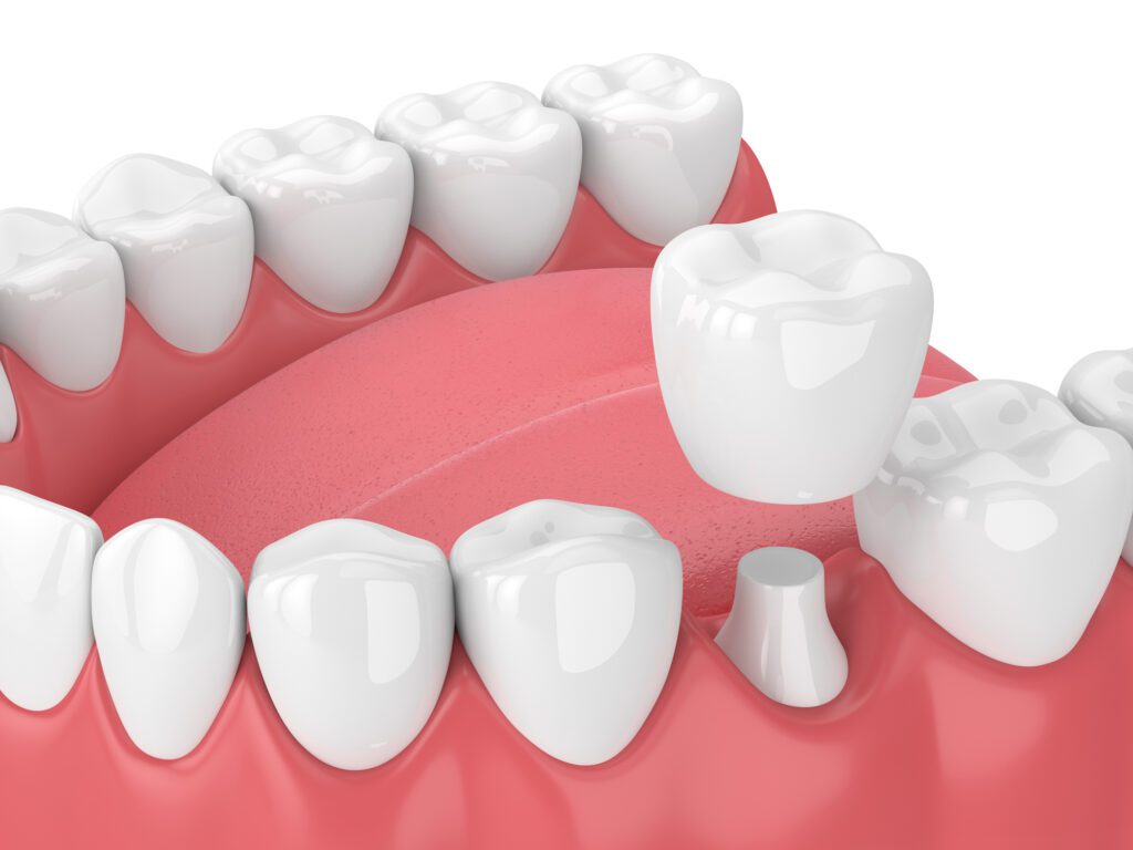 dental crown bethlehem pa