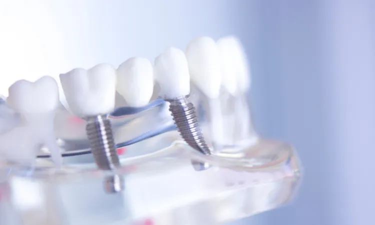 The Benefits of Dental Implants for Tooth Loss in Bethlehem, PA