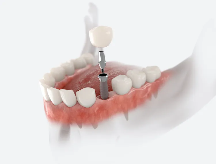 Am I Too Young (or Too Old) for Dental Implants? in Bethlehem, PA